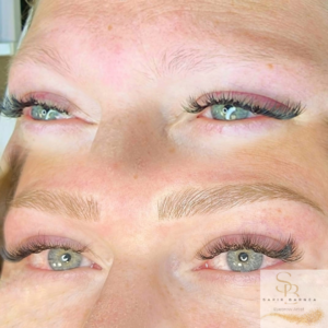 המחשה של תהליך המיקרובליידינג, מראה תקריב של מחט המפקידה פיגמנט בעור.